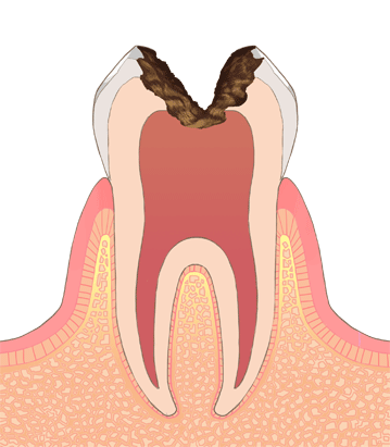 歯の神経に達したむし歯